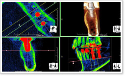 インプラントの診断